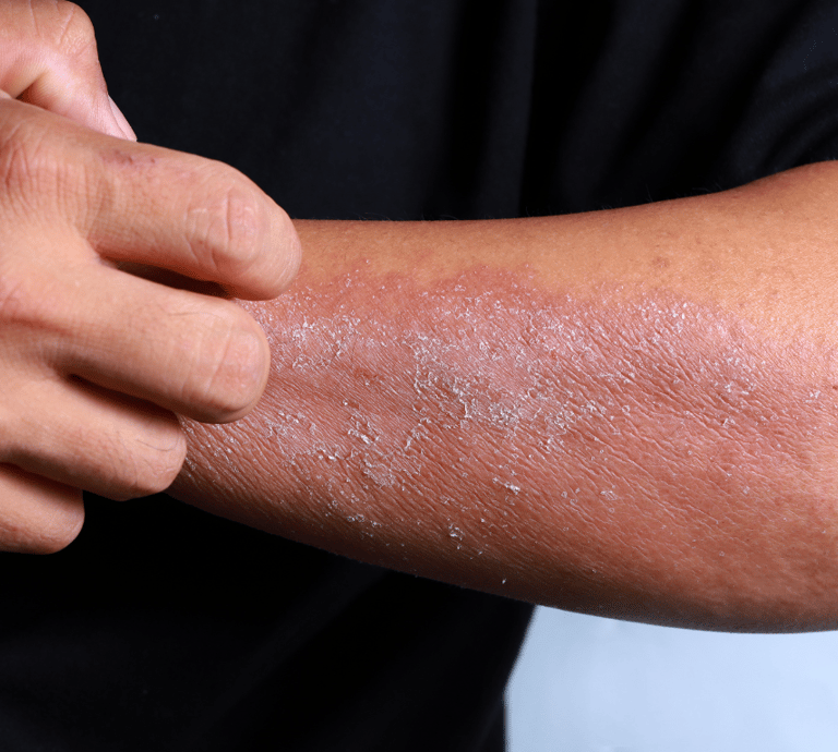 Dry Skin