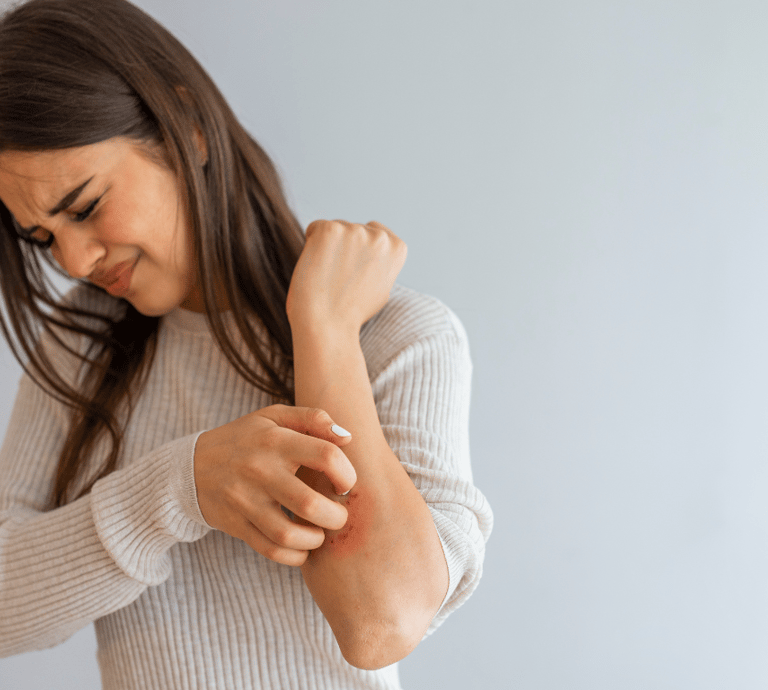 Eczema