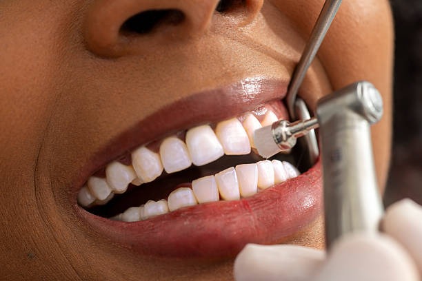 Teeth cleaning greenville SC