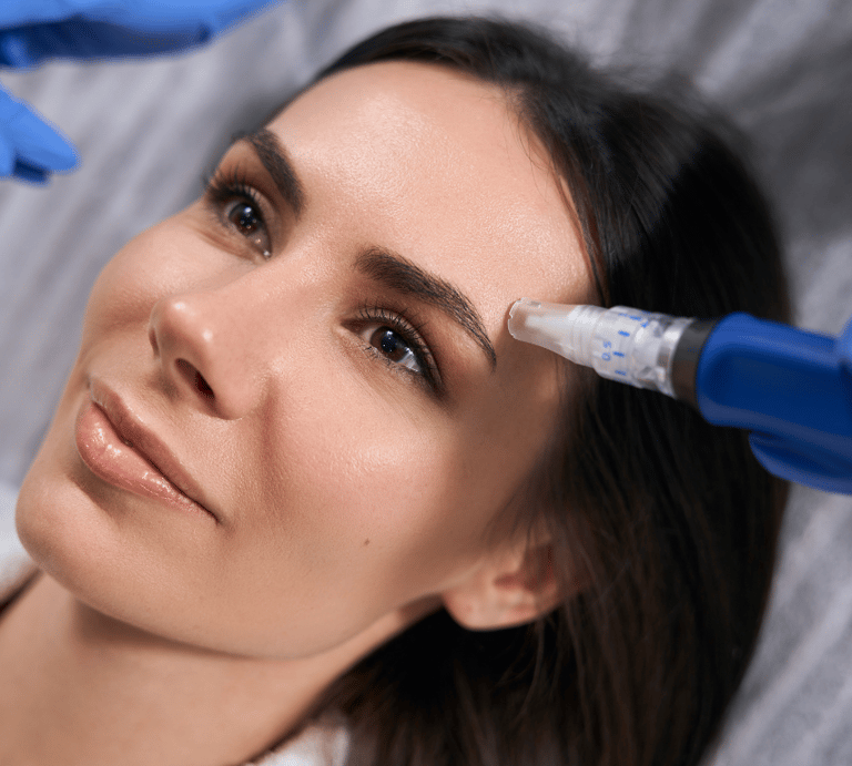 Microneedling