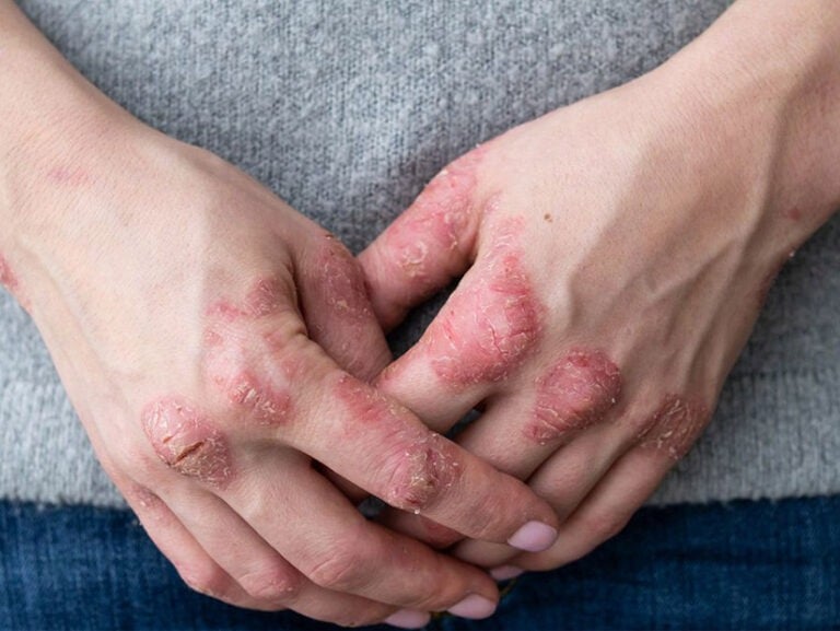 psoriasis ceniza curativa agnihotra homa argentina