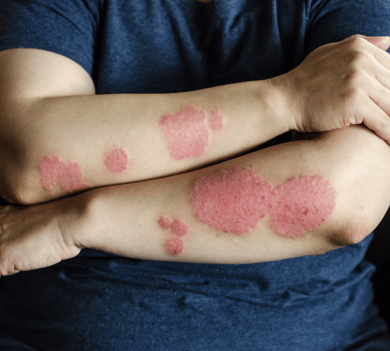 Eczema & Psoriasis Care