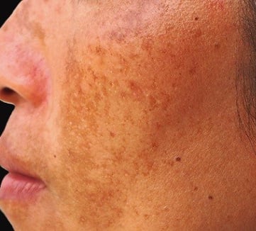 Melasma in a young girl