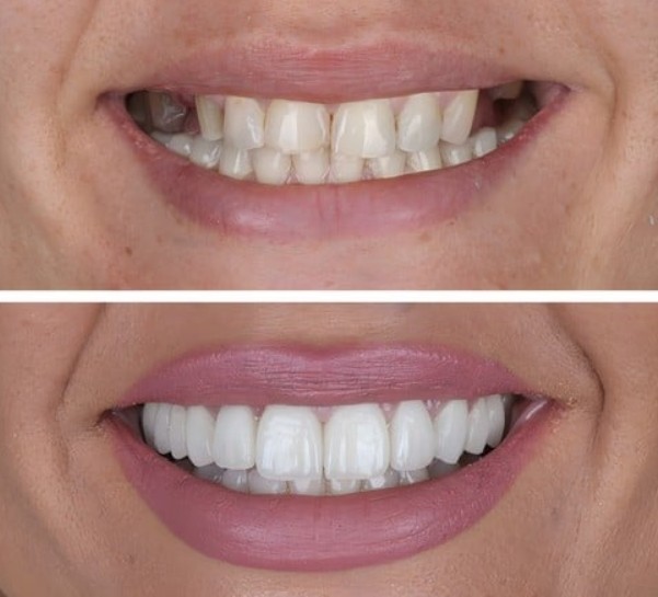 Before and after comparison of a smile makeover using porcelain dental veneers for whiter teeth.