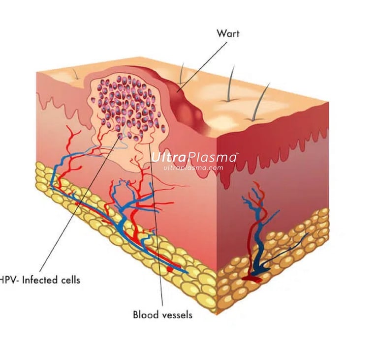 ultraplasma.com_wart_treatment_sigil_tedavisi_ultra_plasma_ultra_plazma_verruca vulgaris