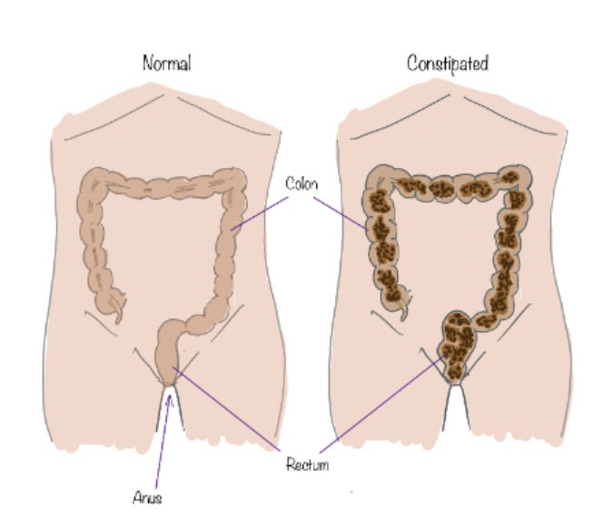 Constipation -ADULT GASTRO FOUNDATION