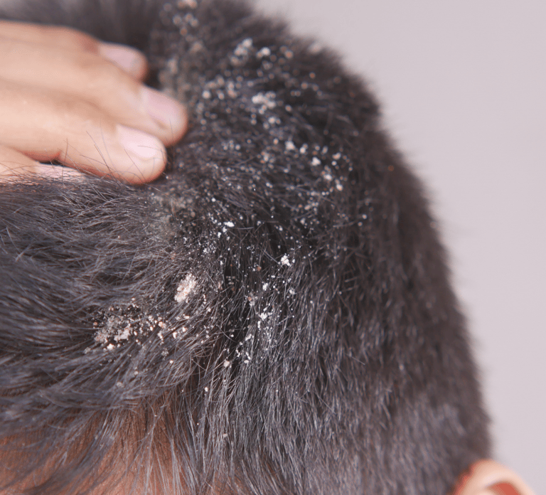 dandruff