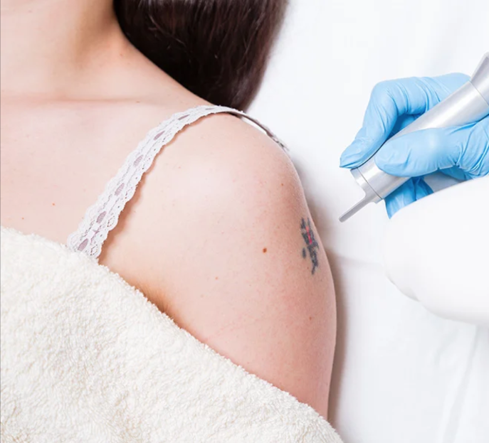 eliminación de tatuajes medianos