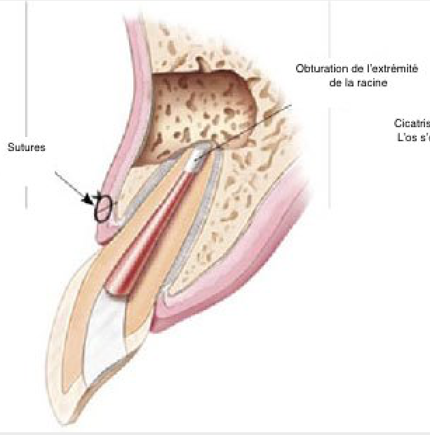 Chirurgie endodontique