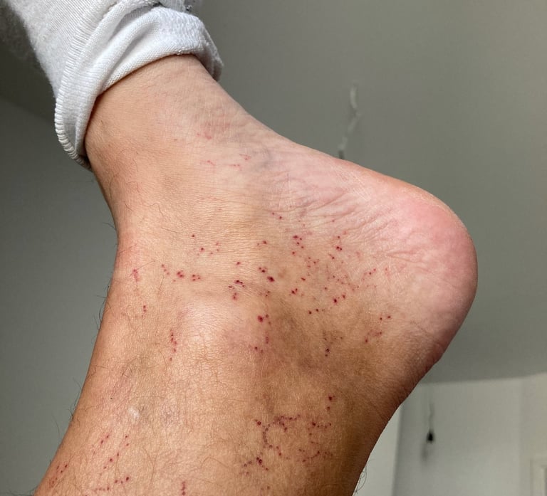 little hematomas on the foot