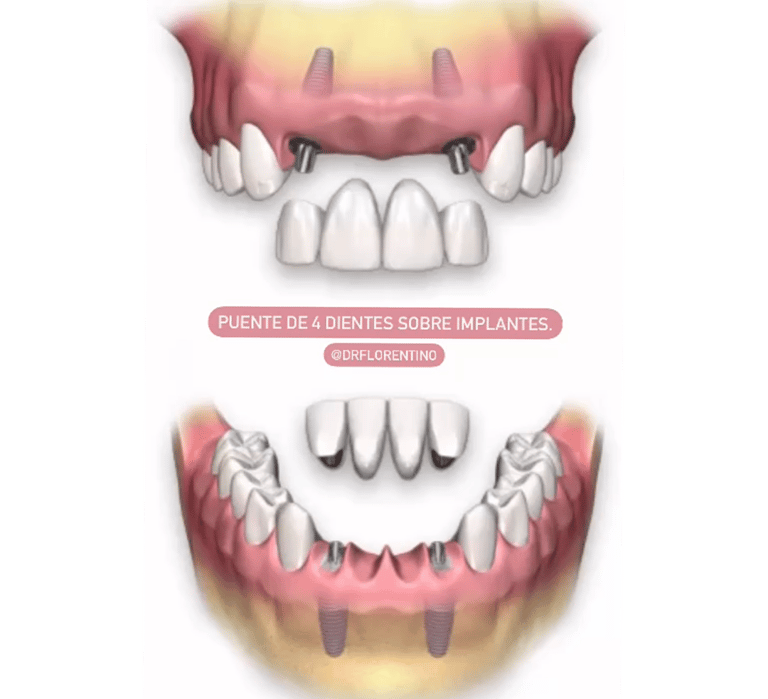 Puente de 4 dientes sobre implantes dentales
