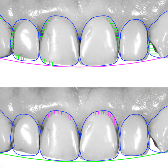 Digital smile design (DSD)