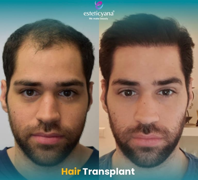 hair transplant before and after