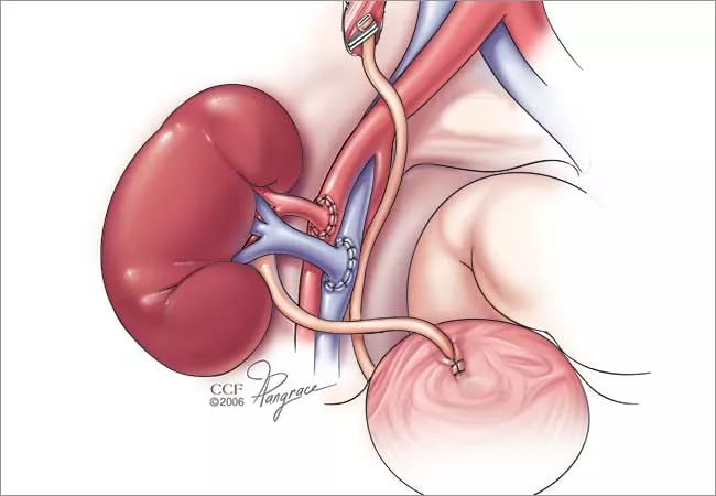 زراعة الكلى د. عمر حمدالله عمان الأردن