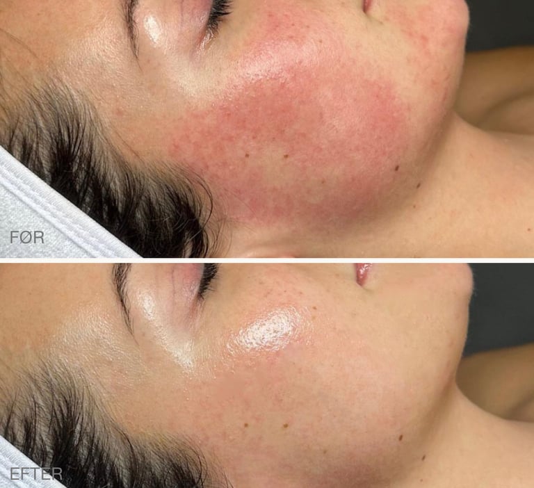 Resultat af behandling med Glass Skin Laser.