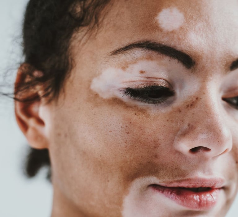 Vitiligo treatment in Vadodara: Find the best skin clinic near you for effective treatment options