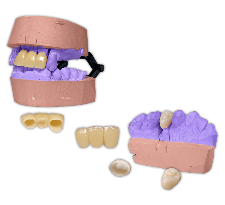 Protesis-Fija-Estetica-Acrilico-Ivocron
