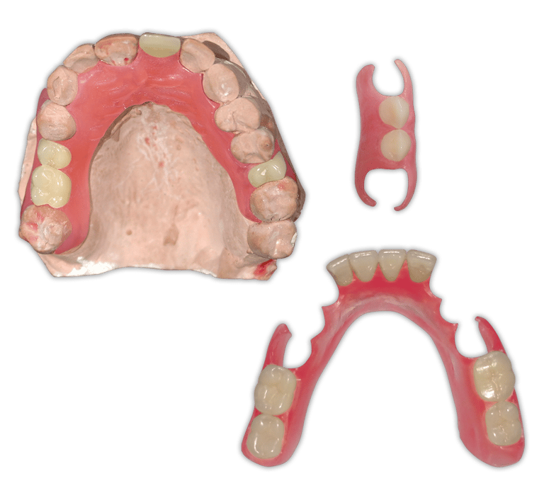Protesis-Removible-Flexible-Valplast