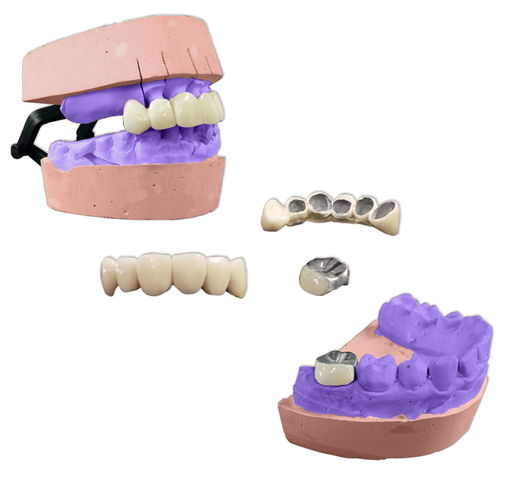 Protesis Fija Metal Acrilico Ivocron
