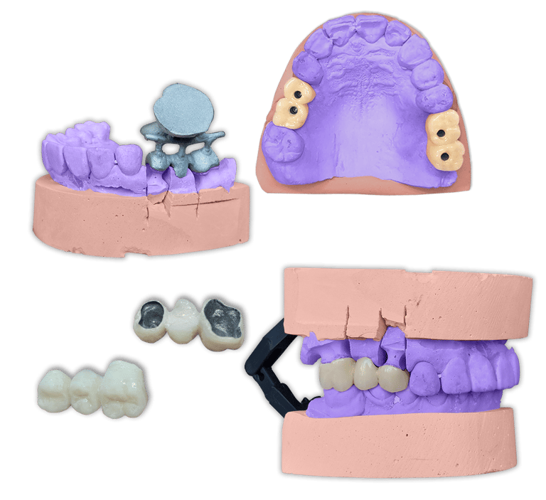 Protesis Fija Metal Porcelana IPS InLine