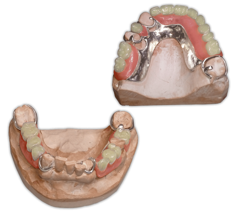 Protesis-Removible-Metal-Acrilico