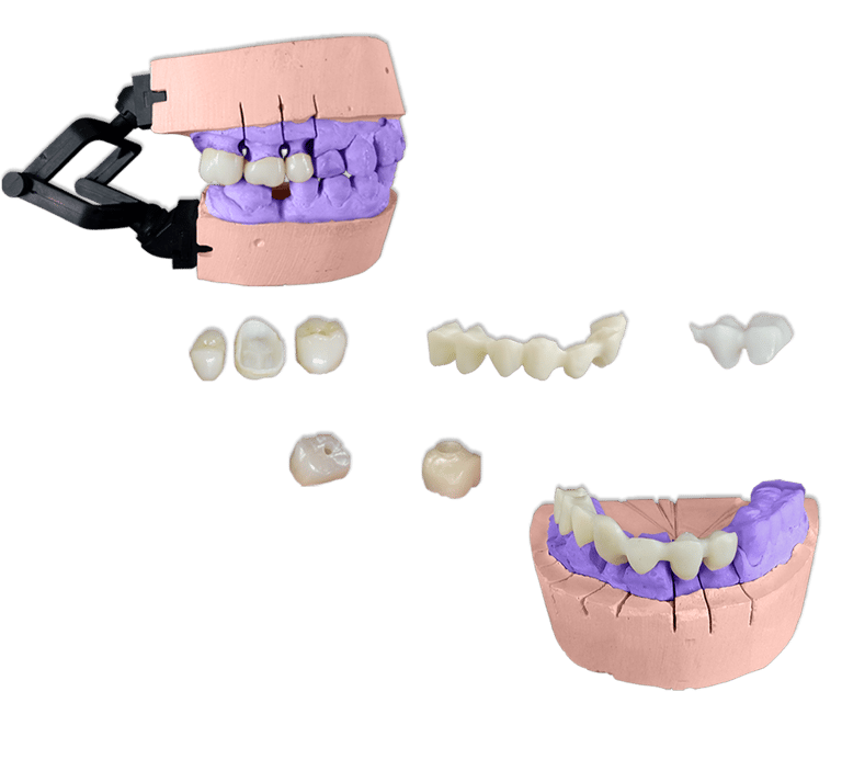 Protesis Fija Estetica Zirconia