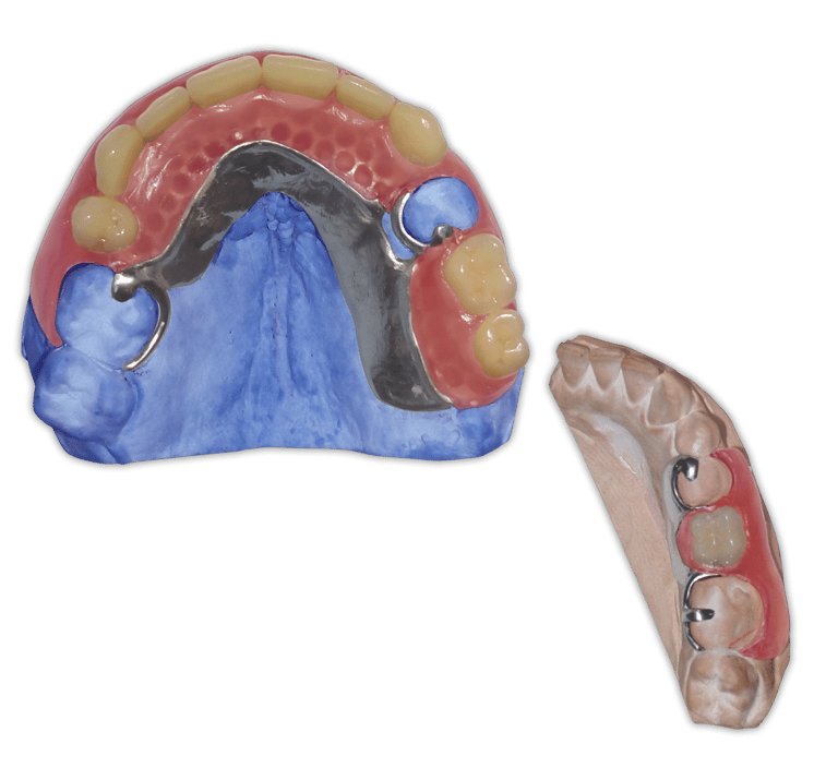 Protesis-Removible-Hibrida-Metal-Flexible-Valplast