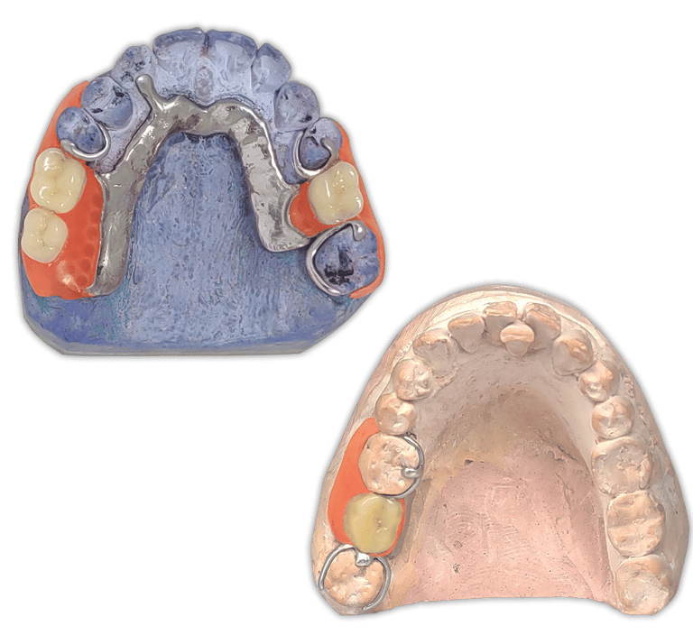 Protesis-Removible-Hibrida-Metal-Flexible-PartialFlex