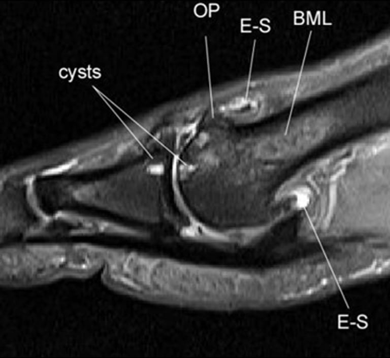 MRI slice of the first MTP joint showing labeled features: bone marrow lesions, cartilage loss and osteophytes