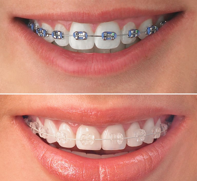 Orthodontic Treatment at dentosculpt