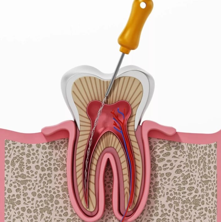 Cross-section medical illustration of a root canal procedure on a human molar tooth.