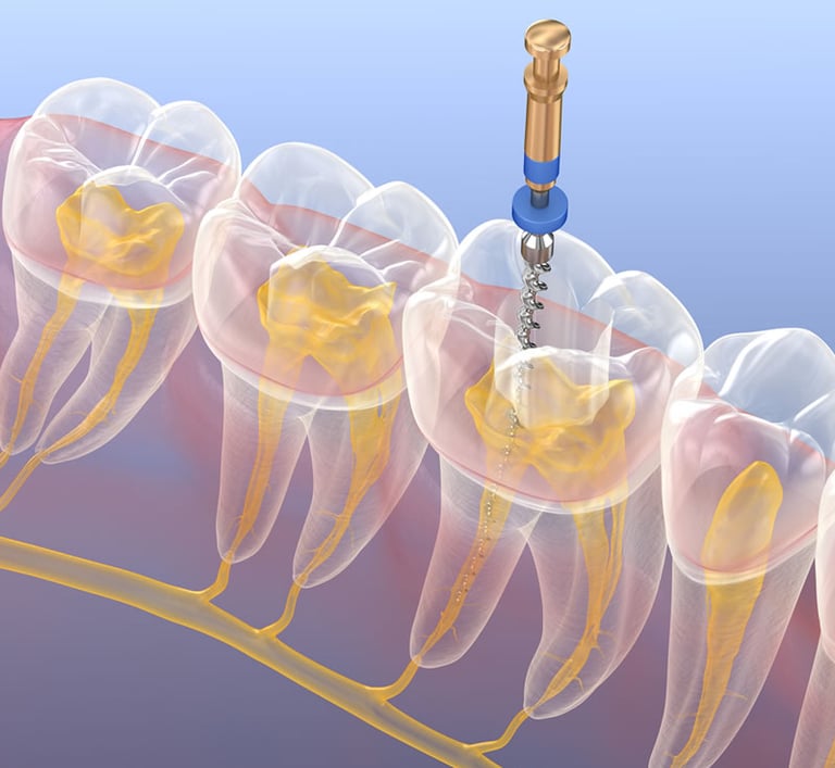 3D dental illustration showing a root canal procedure using an endodontic file to clean tooth pulp.