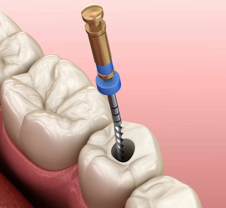 3D illustration of a dental endodontic root canal procedure on a molar tooth.
