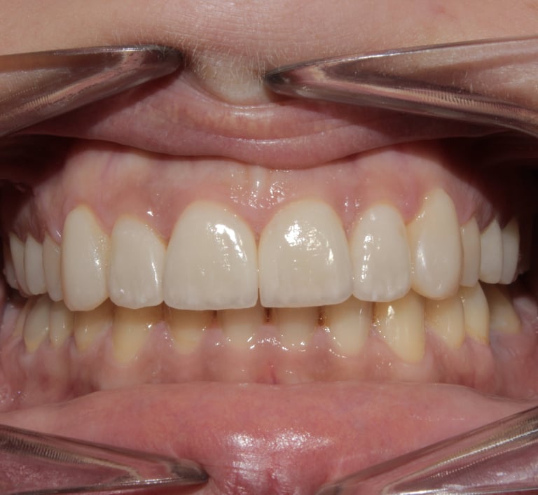 Faccette dentali Studio Dentistico Vivaldini