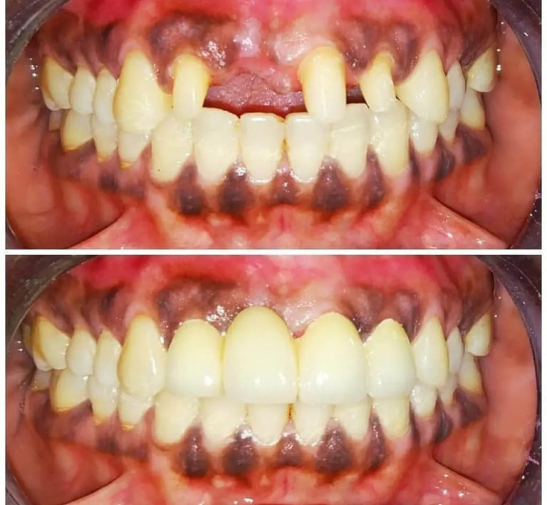 Metal Free Zirconia Crowns and Bridges Before After