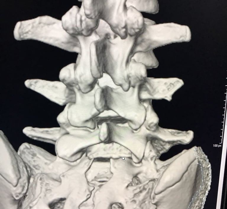 reconstruccion 3d de columna lumbar y sacra