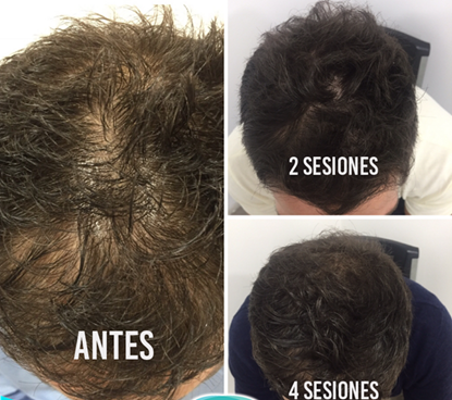 Mesoterapia para la caida del cabello 