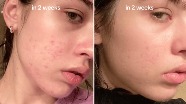 Before and after skin transformation showing reduction in facial acne and redness over two weeks.