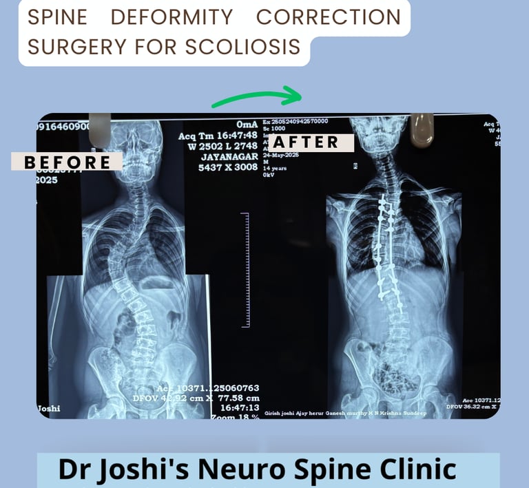 scoliosis surgery in Bangalore