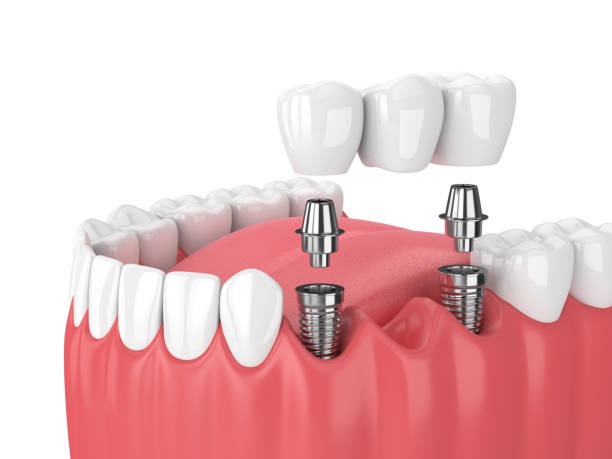 multiple dental implant