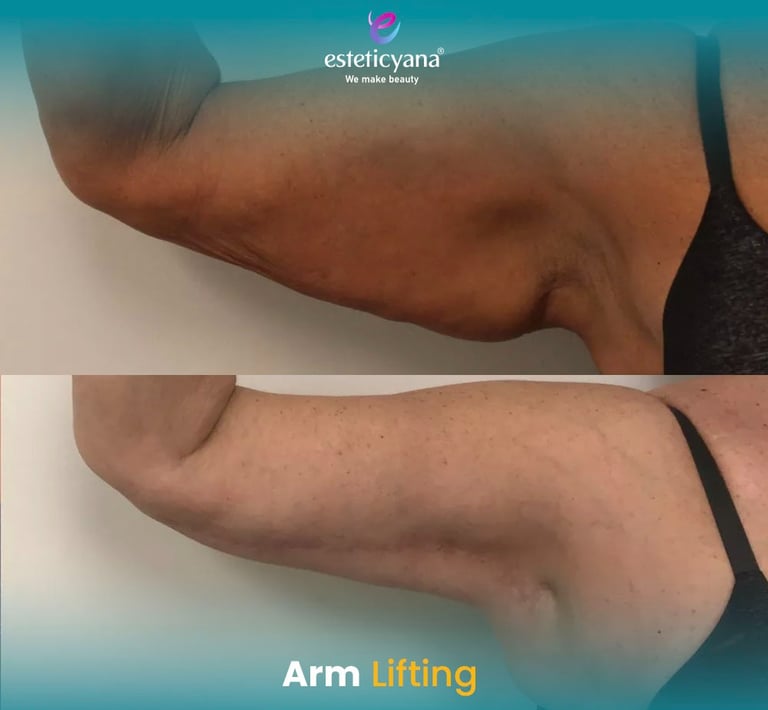 Arm lift before and after