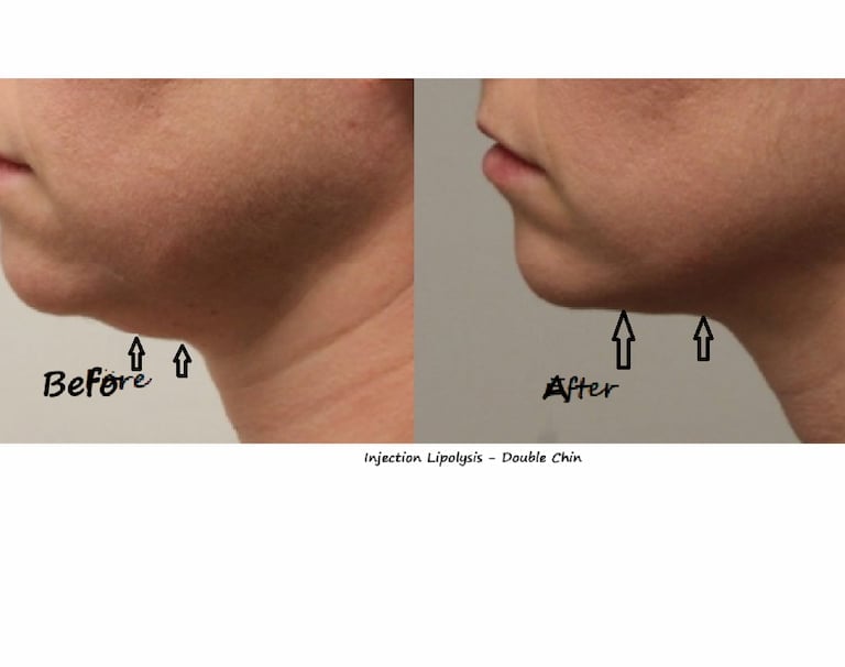 Fat reduction Delhi before and after photo – injection lipolysis double chin, male 20 yrs.
