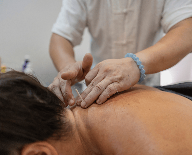 Acupuncturist applying needles to patient's neck