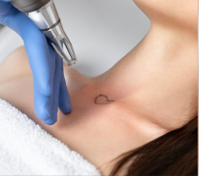 eliminación de tatuajes pequeños