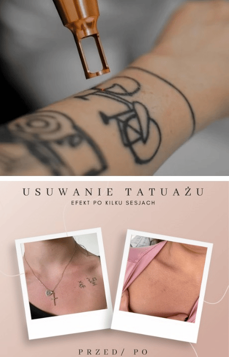 usuwanie tatuaży efekt przed po