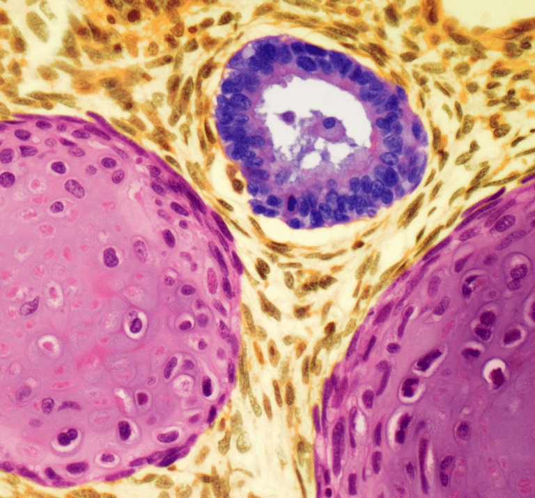 Testis kanserini gösteren bir çizim