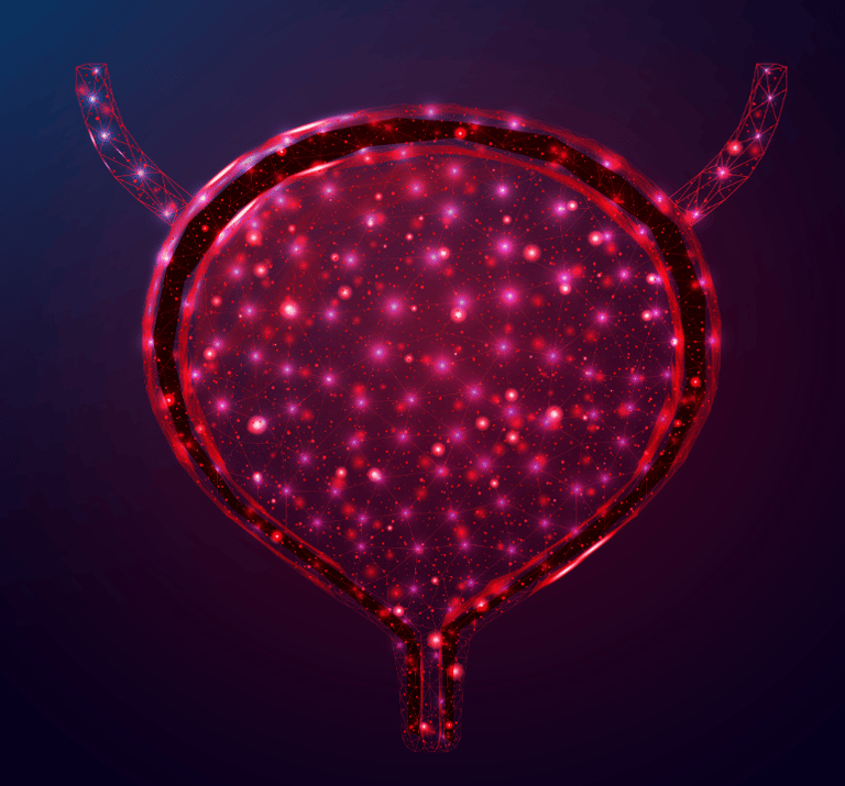 Mesane kanserini gösteren bir çizim.