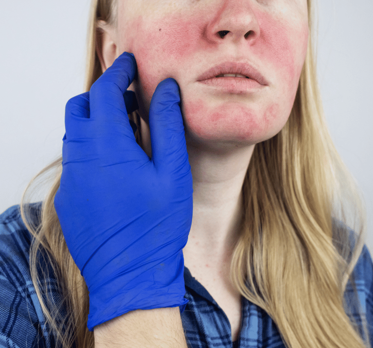 Rosacea Treatment