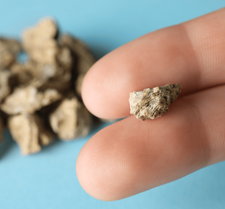 Bir kişi parmaklarının arasında böbrek taşlarını tutup, kameraya gösteriyor. Yakın plan