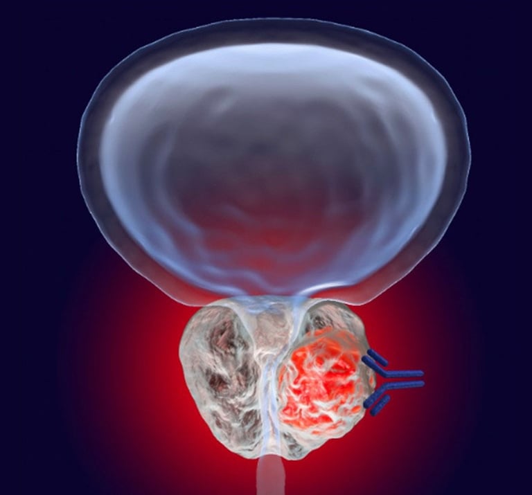 BPH gösteren bir çizim